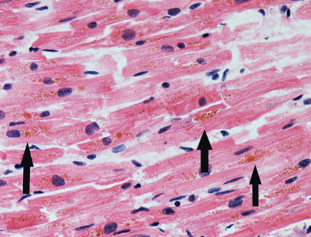 心肌褐色萎缩_病理标本博物馆-复旦大学基础医学院