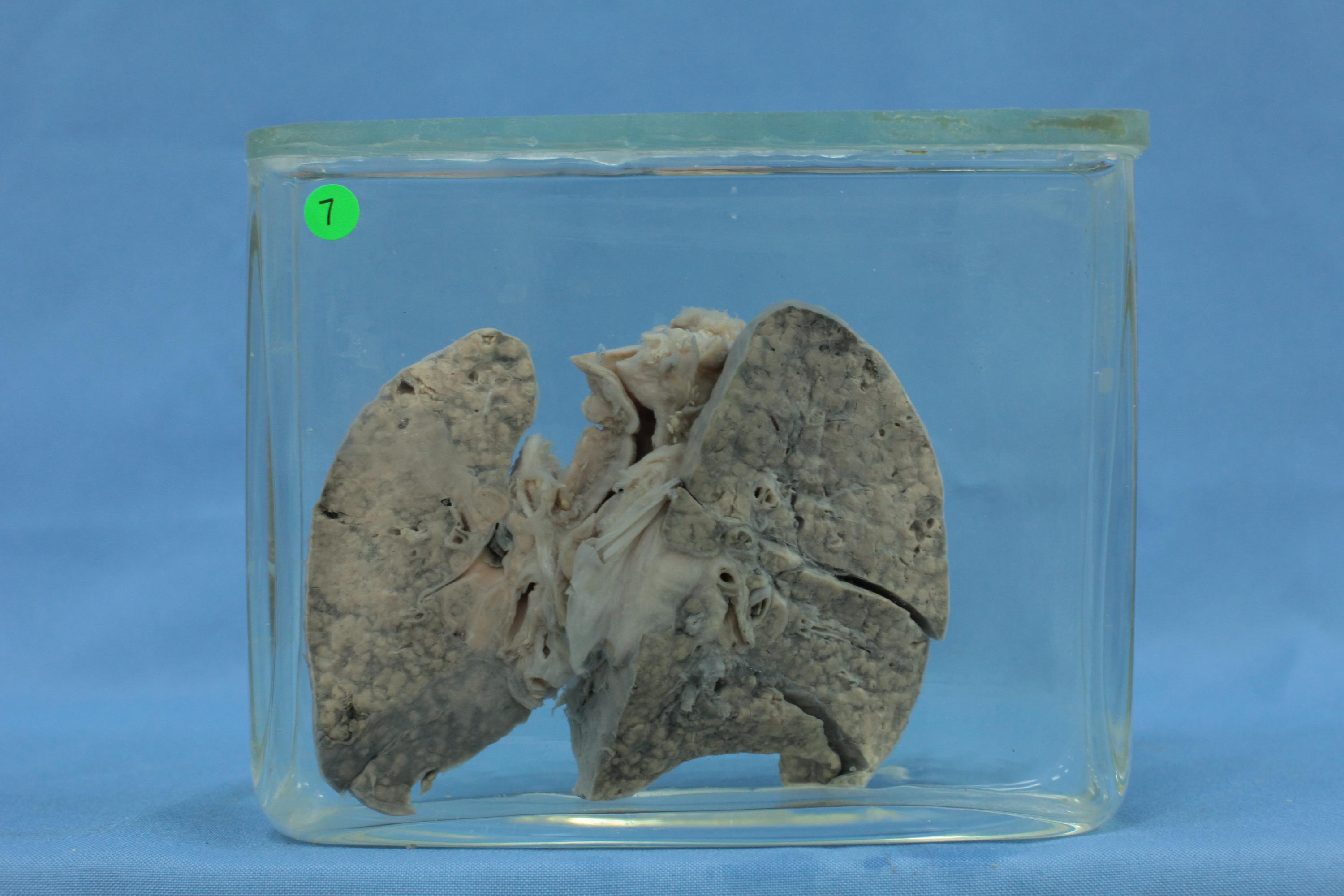 非结核分枝杆菌肺部感染如何诊治？上海专家经验全分享|上海市|肺结核_新浪新闻